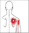 triger points on scapula and pain pattern